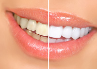 Why Whitening Your Teeth at Home May Not Be the Convenient Money-Saver You Think It Is