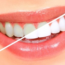 Your Teeth Can Be Whiter Than Ever Through Cosmetic Dentistry in St George UT
