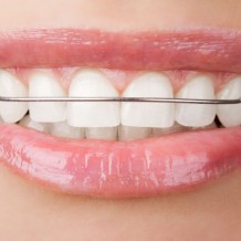 When Do Braces Become A Necessity?
