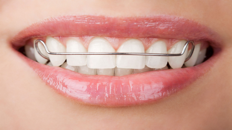 When Do Braces Become A Necessity?