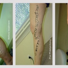 Effective Minimally Invasive Varicose Vein Surgery