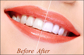 Are You Looking for Teeth Whiteners in Alexandria, VA?