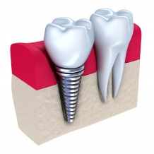 What Happens When You Get Teeth Implants in Apple Valley MN?