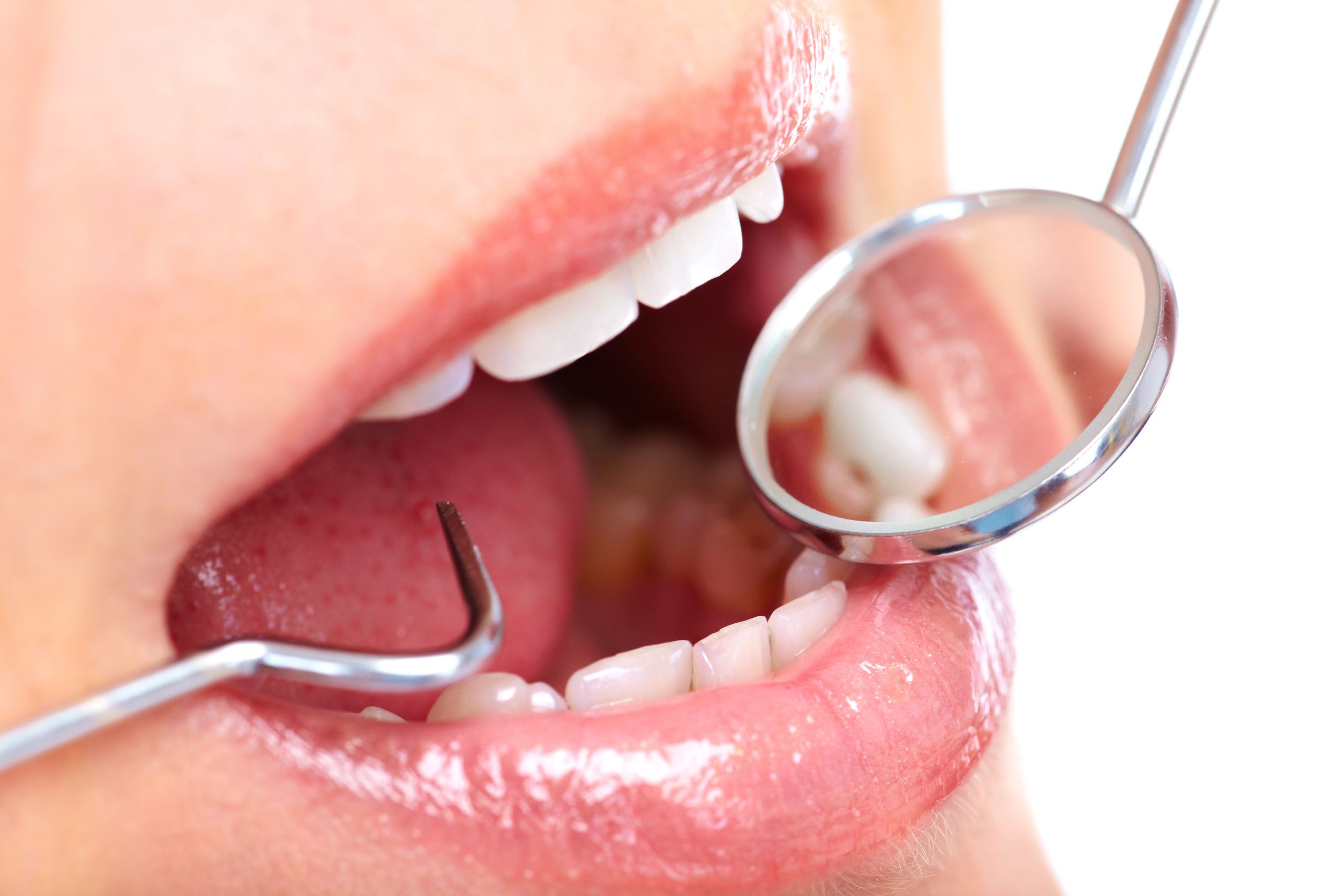 Signs it’s Time to Find a Periodontic Service in California, MD for Treatment of Gum Disease