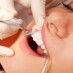 Repair Damaged Teeth with Bonding