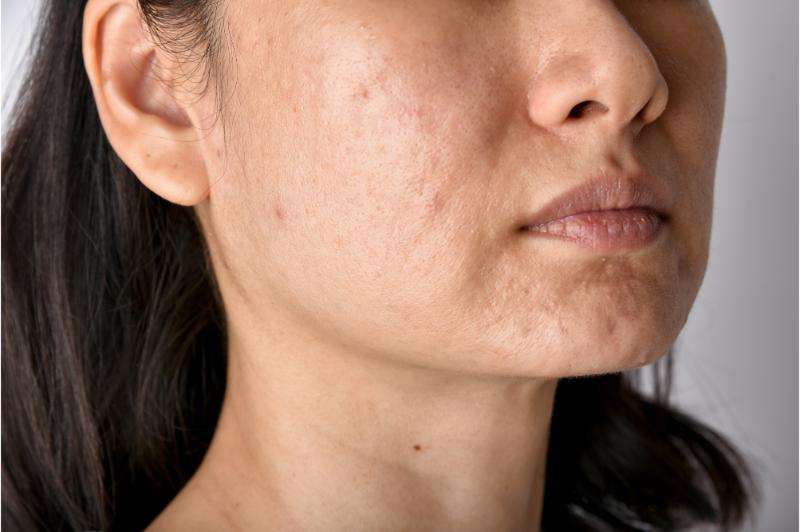Turn Back the Clock and Reclaim Your Energy: The Anti-Aging Effect of IV Therapy in Miami Beach, FL