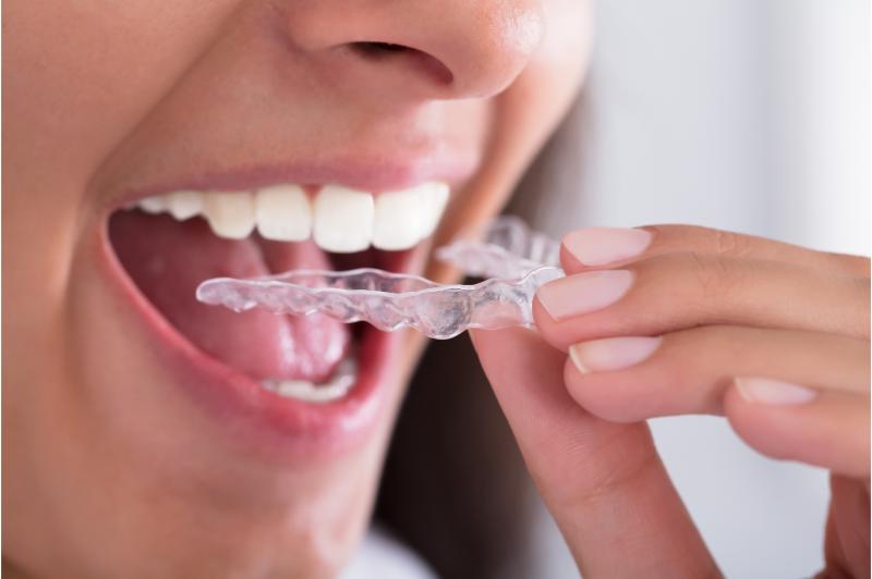 Transform Your Smile with Dental Bridges in Downers Grove Expertise